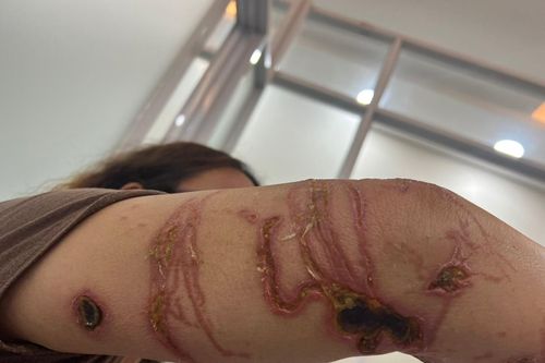 Bị nhiễm trùng da vì bị sứa lửa đốt