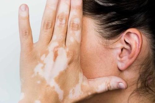 Phương pháp điều trị bệnh bạch biến