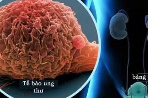 Câu hỏi thường gặp liên quan đến ung thư bàng quang