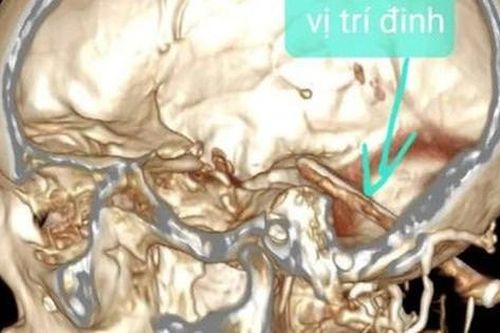 Người đàn ông bị cây đinh đâm vào não suốt một năm