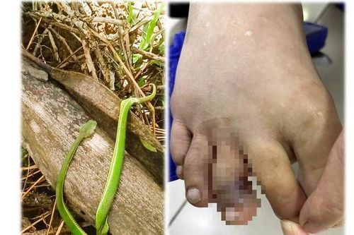 Người phụ nữ 38 tuổi ở Phú Thọ bị rối loạn đông máu do tai nạn dễ gặp trong mùa mưa