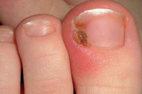 Móng chọc thịt xử trí thế nào?