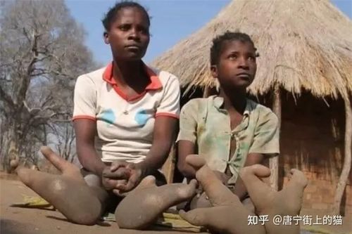 Bí ẩn về bộ tộc 'đà điểu': Không thể đi giày vì thiếu ngón chân!