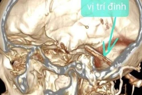 Cây đinh dài 7cm nằm trong đầu cả năm mà không biết