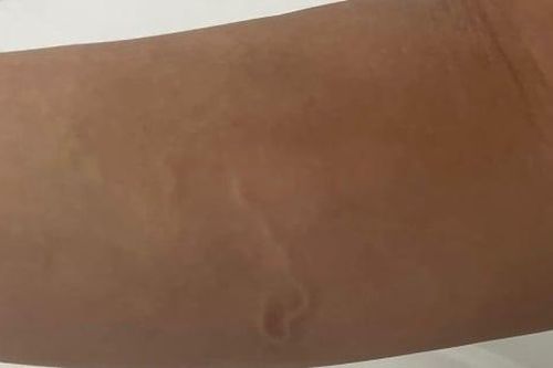 Giun dài 30cm từ cơ thể nam thanh niên, 'thủ phạm' từ 1 món ăn