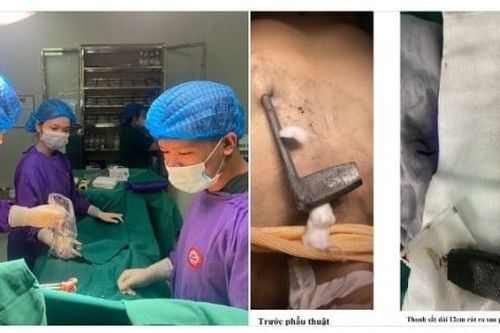 Người đàn ông 39 tuổi bị thanh sắt đâm xuyên ngực