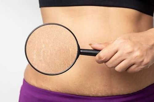 7 cách tự nhiên và dễ dàng để giảm vết rạn da