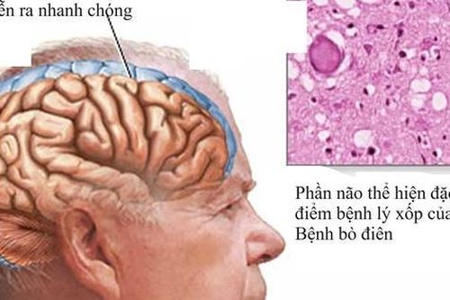 Điều trị bệnh bò điên thế nào?