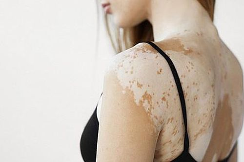 Chế độ ăn cho người bệnh bạch biến