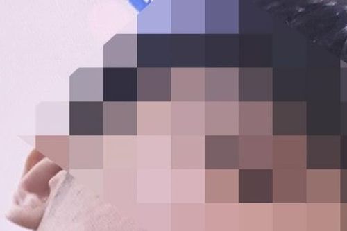 Nhập viện cấp cứu sau khi nặn mụn trên mặt