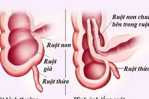 Trẻ 10 tháng tuổi bị hoại tử ruột do lồng ruột, cách nhận biết sớm căn bệnh nguy hiểm này