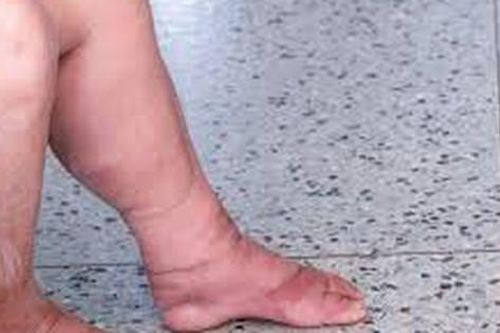 Điều trị bệnh chân voi như thế nào?