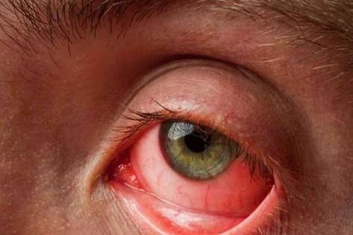 4 điều cần biết để phòng bệnh đau mắt đỏ mùa mưa