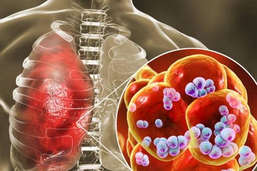 Phế cầu khuẩn - 'thủ phạm' gây ra nhiều bệnh nguy hiểm