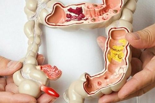 Các phương pháp điều trị bệnh Crohn