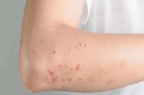 Dấu hiệu bạn đã nhiễm ký sinh trùng