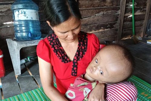 Cháu bé đầu to cần được giúp đỡ