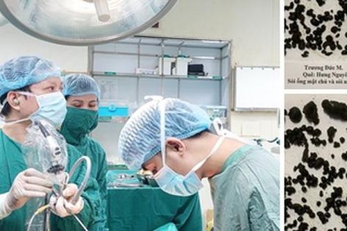 Phẫu thuật lấy gần 1.000 viên sỏi đường mật trong gan bệnh nhân