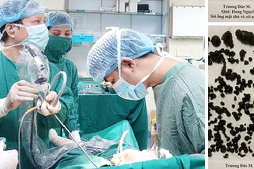 Phẫu thuật nội soi lấy gần 1000 viên sỏi đường mật trong gan