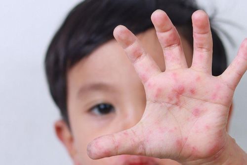 Các biểu hiện bệnh tay chân miệng cần chú ý ở trẻ