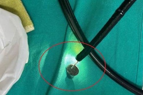 Bé trai 8 tuổi nuốt đồng xu vào dạ dày
