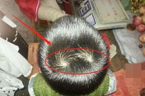 Trẻ có hơn '2 vòng xoáy' trên đầu có nghĩa là gì? Có liên quan đến chỉ số IQ không?