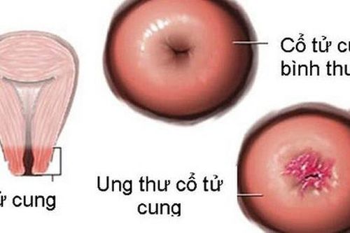 Người bệnh ung thư tử cung nên vận động như thế nào?