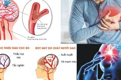 4 việc cần làm ngay khi ngủ dậy để phòng ngừa đột quỵ
