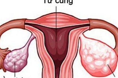 Bài tập nâng cao sức khỏe cho người bệnh ung thư buồng trứng