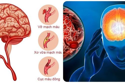 7 dấu hiệu cảnh báo cơn đột quỵ sắp xảy ra