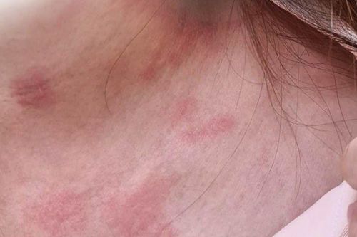 Gia tăng ca viêm da tiếp xúc do kiến ba khoang khi mùa mưa tới