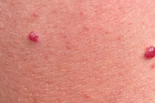 Mảng đỏ như nốt ruồi trên da là do tụ máu hay nốt ruồi ung thư?