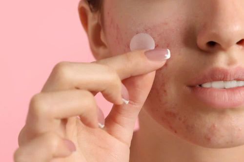 Điều ít biết về miếng dán mụn