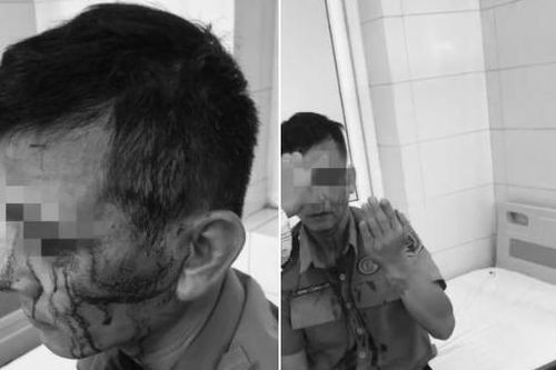 Bảo vệ Bệnh viện K bị hành hung dã man, phải khâu 8 mũi