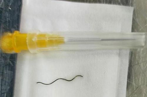 Xử trí trường hợp dây thép đâm xuyên nhãn cầu