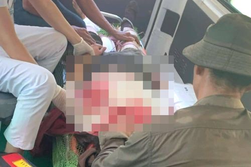 Người phụ nữ bị đá lớn lăn trúng người khi đi làm rừng, chấn thương sọ não