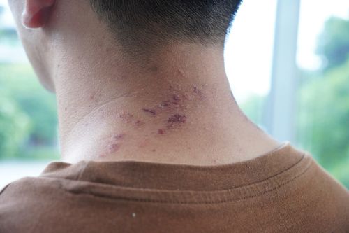 Nhiều trẻ vào viện vì kiến ba khoang