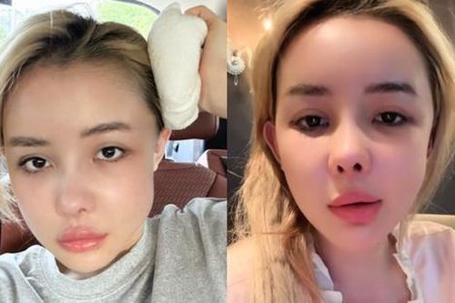 Khuôn mặt của Ngân 98 bị sưng méo hậu can thiệp 'dao kéo'