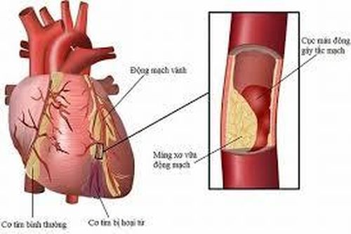 Bệnh mạch vành có di truyền không?