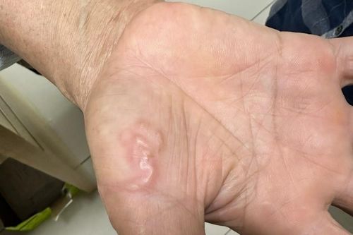 Ngứa sẩn khắp người vì nuôi chó mèo