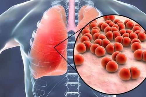 Nâng cao khả năng kiểm soát và điều trị hiệu quả bệnh do vi khuẩn phế cầu gây ra