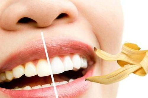 Bí quyết làm trắng răng đơn giản tại nhà