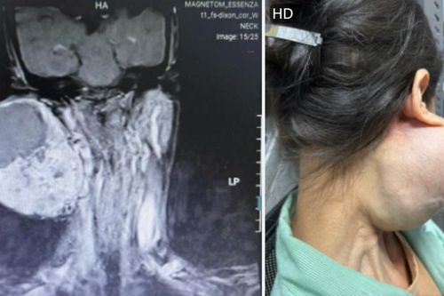 Người phụ nữ suýt mất mạng vì đeo khối u khổng lồ trên mặt suốt 14 năm
