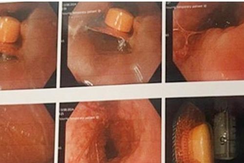 Nhập viện vì viên thuốc còn nguyên vỏ cắm sâu vào thực quản