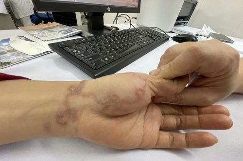 Giun bò lổm ngổm dưới da người phụ nữ nuôi 3 con chó, 5 con mèo