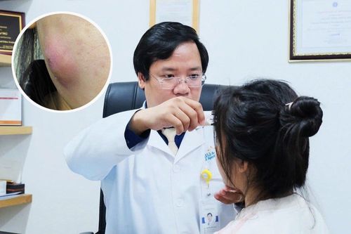 Suýt hoại tử mặt do tự ý nặn mụn
