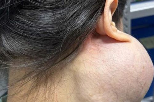 Suýt mất mạng vì khối u khổng lồ làm biến dạng khuôn mặt