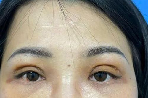 Mắt chảy dịch, không thể nhắm kín sau thực hiện cắt mí ở spa