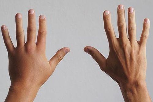 Buổi sáng ngủ dậy bị sưng tay do đâu? Có phải bệnh khớp không?