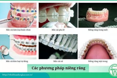 Có nên niềng răng tại Nha Khoa Đăng Lưu hay không?